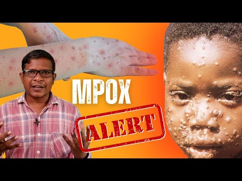 Monkey Pox या MPox क्या है? कैसे पहचाने और Infection से बचाएँ अपने परिवार को?