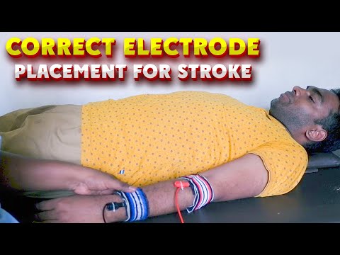 Electrode Placement for Stroke | Foot drop, Wrist &amp; Finger Extension