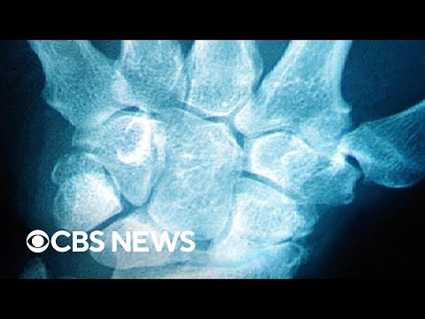 Rheumatoid arthritis isn&#039;t your grandmother&#039;s arthritis, affecting anyone at any age