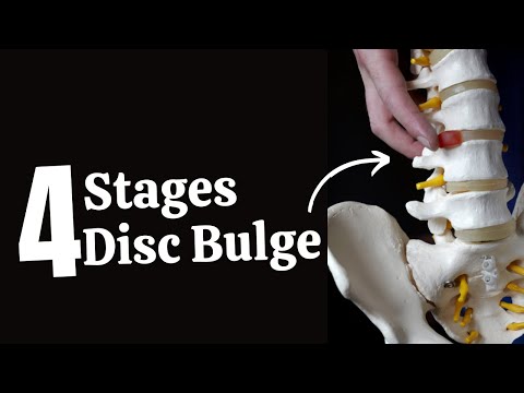 4 Stages of Disc Bulge/ Prolapse in Sciatica or Cervical Radiculopathy