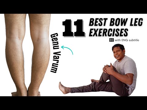 11 Easy Genu Varum Exercises for Bow Leg Correction