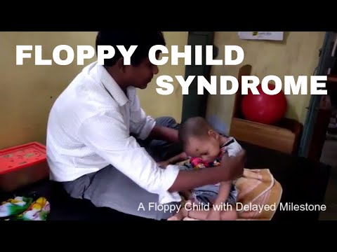 Floppy Child Syndrome: Child like a &quot;Rag Doll&quot;, even unable to hold head straight.