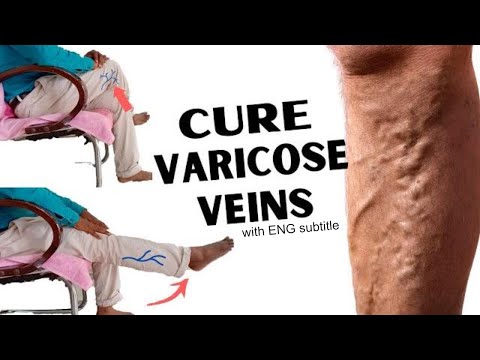 वेरीकोस वेंस का घरेलू उपचार| 8 BEST Varicose Veins Exercise