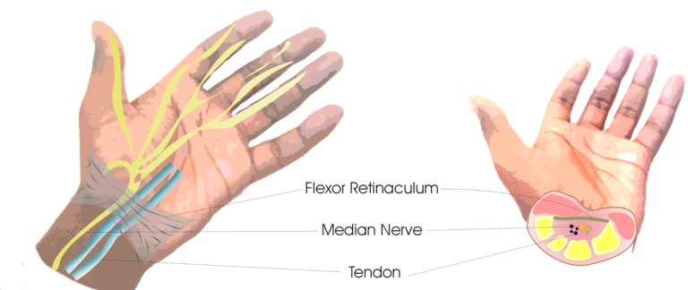 5 Best exercise for carpal tunnel wrist pain, causes & symptoms ...
