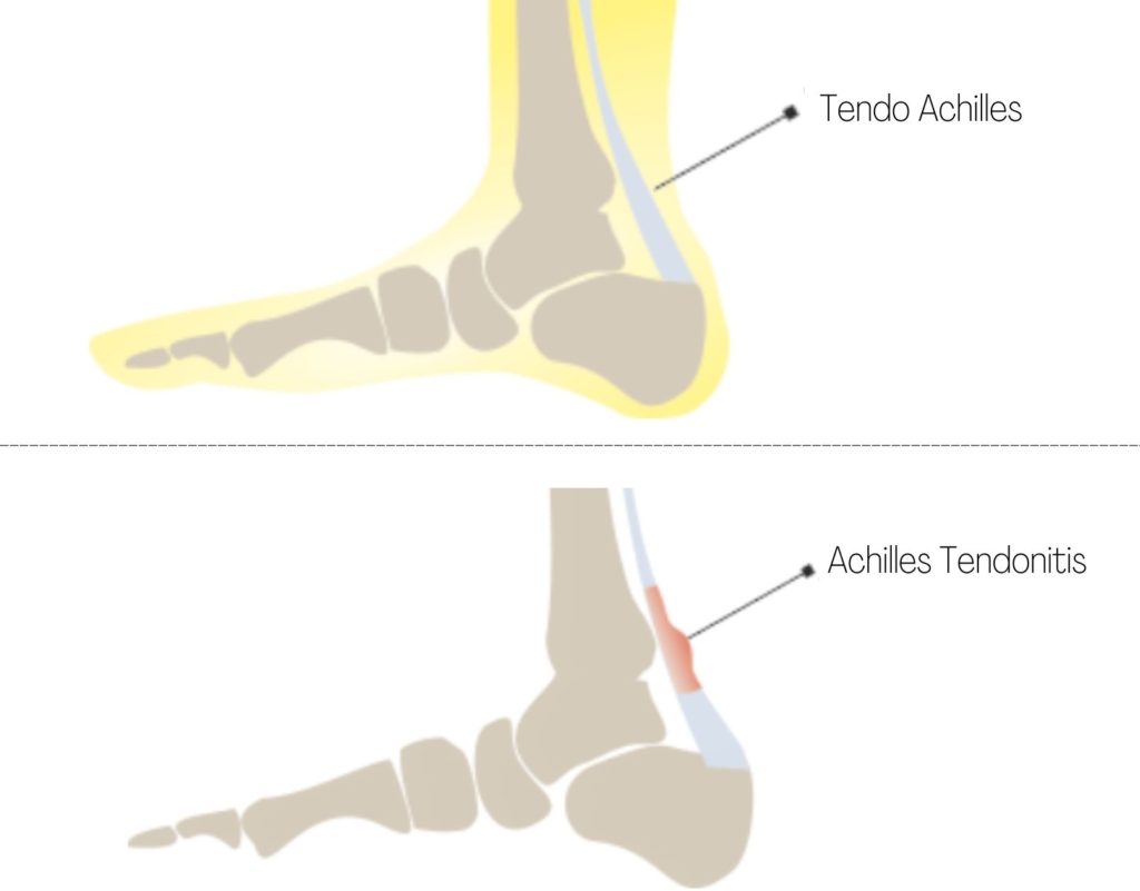achilles tendonitis physiotherapy exercises
