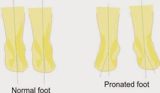 pronated foot Optimized