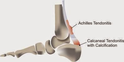 insertional calcific achilles tendonitis