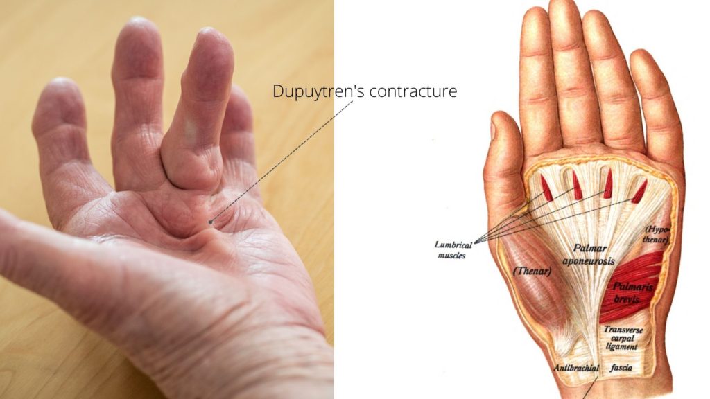 Dupuytren's contracture anatomy