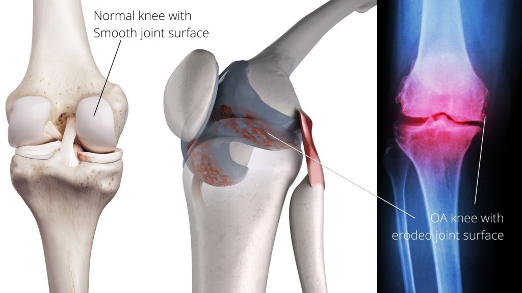 xray of knee with osteoarthritis