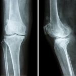 xray of knee with osteoarthritis OA