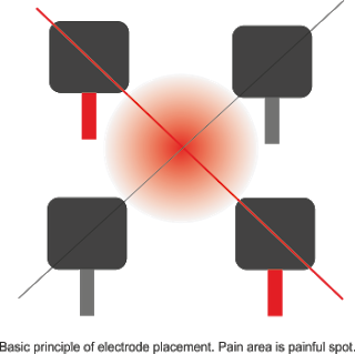 ift electrode placement