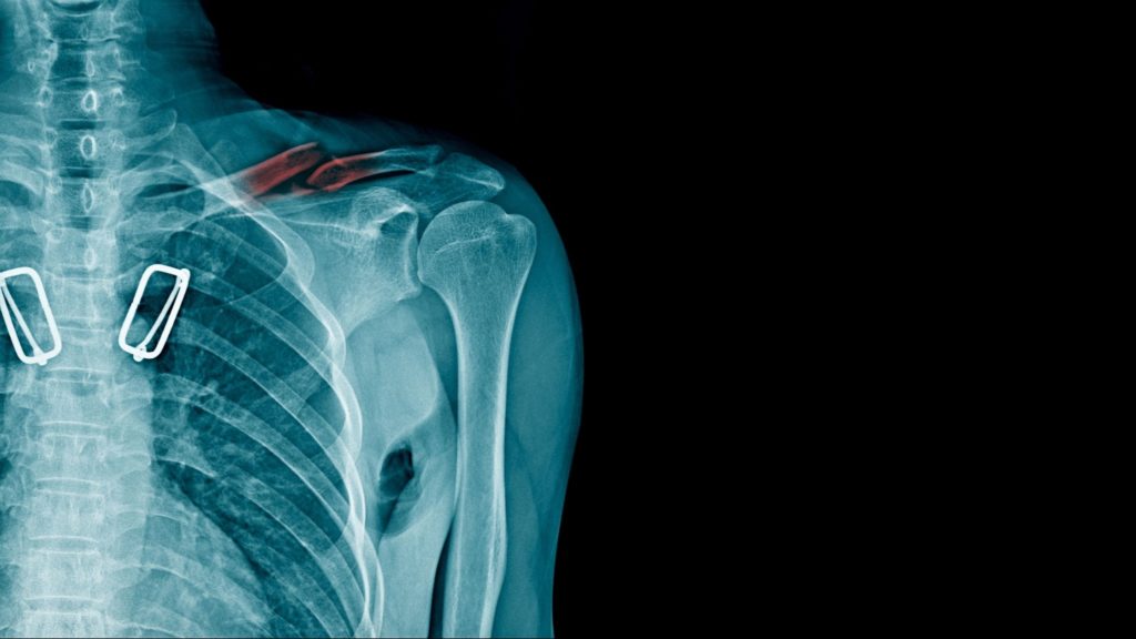 clavicle fracture physiotherapy