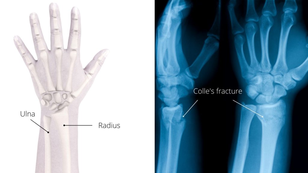 colles fracture wrist