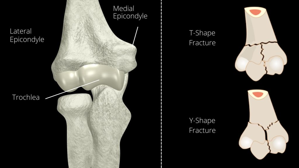 classification of intercondylar fracture humerus