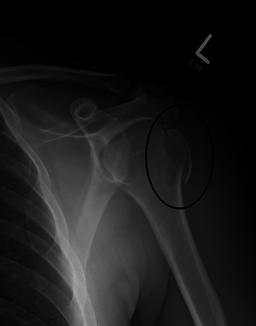 greater tuberosity fracture radiography