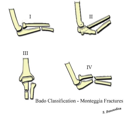 monteggia fracture bado classification