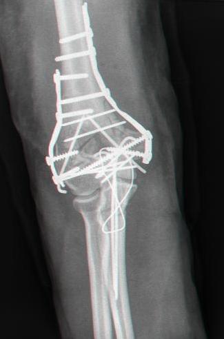 intercondylar fracture of humerus radiology