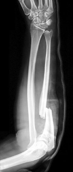 monteggia fractures radiology