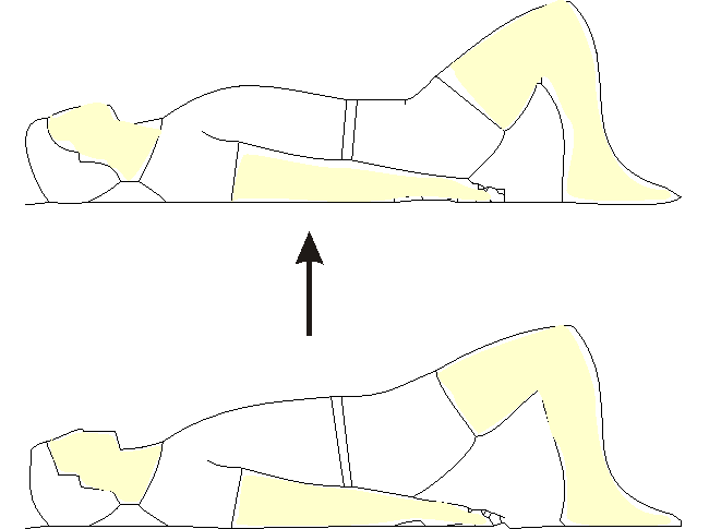 physical therapy for sciatica: bridging exercise in sciatica