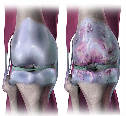 Osteoarthritis knee, which is worse rheumatoid arthritis or osteoarthritis
