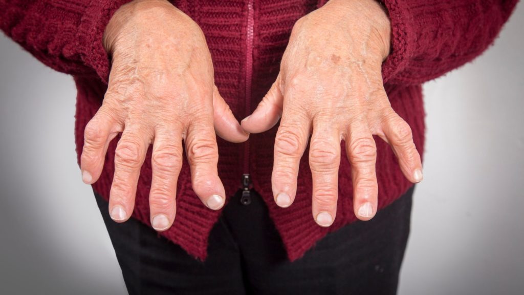 RA hand, is rheumatoid arthritis worse than osteoarthritis