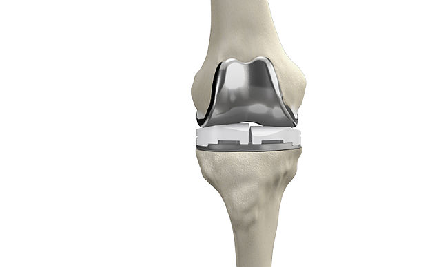 total knee replacement/ tkr