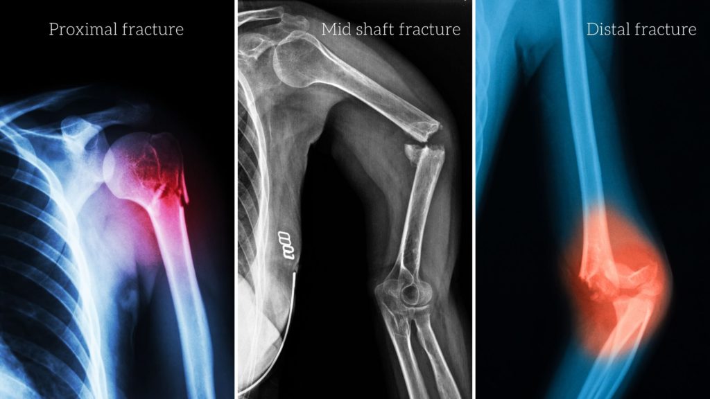 classification of humerus fracture