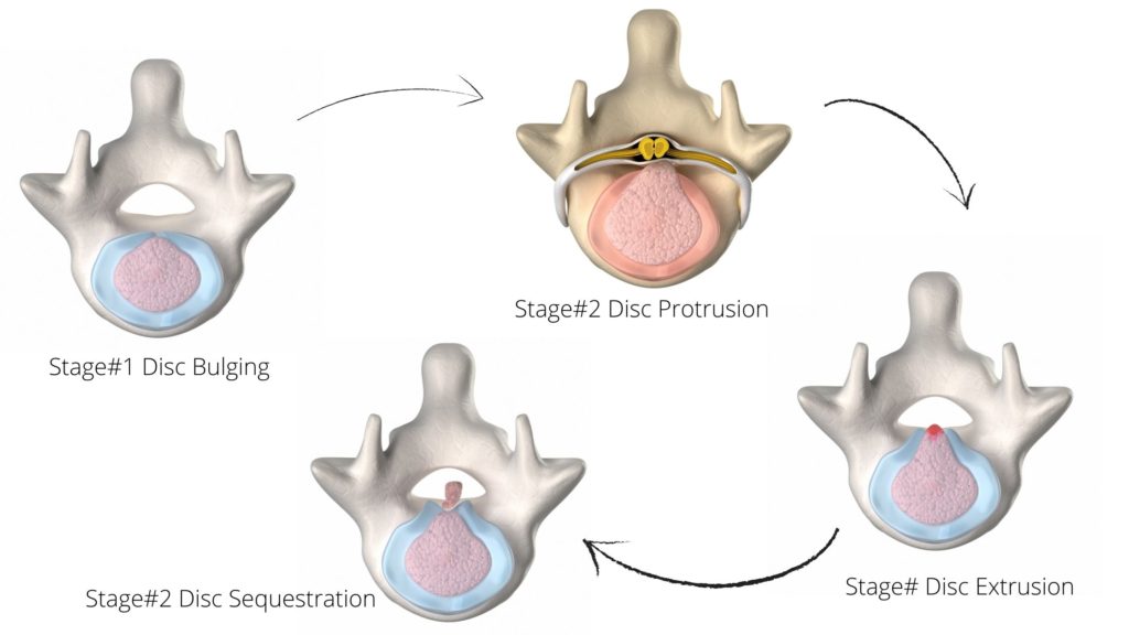 4 stages of disc herniation