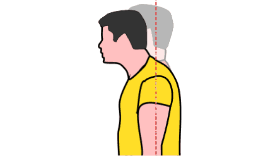 fix posture permanently