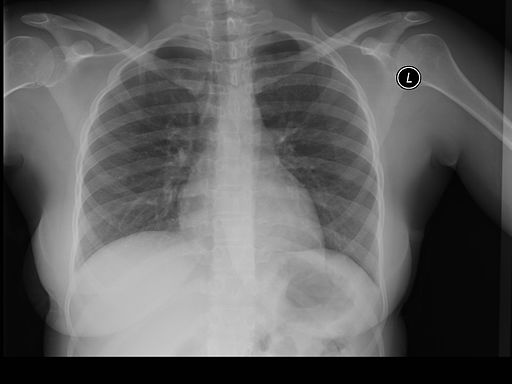 Chest X-ray has hidden info of our motality, AI can predict it