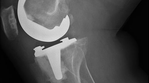 cropped partial knee replacement as effective as TKR