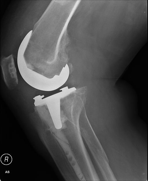 partial knee replacement as effective as TKR