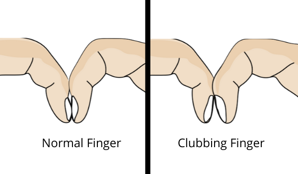 Schamroth window test or the diamond hole finger test