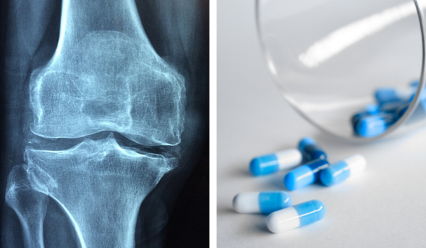 new arthritis drugs can stop bone degeneration finds study