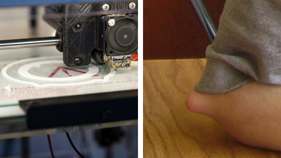 3D print tech saves girls leg being cut for tumor surgery