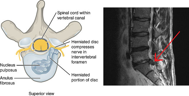 herniated lumbar disc cause of sciatica