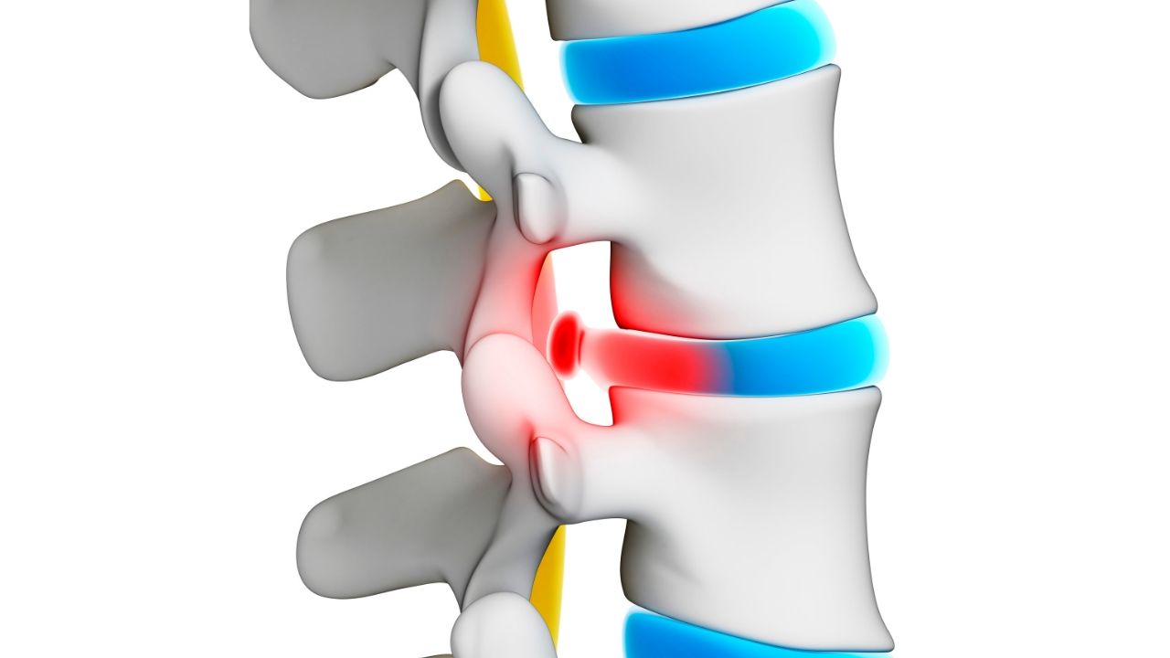 6 Best Exercises for Disc Herniation Sciatica : Physiosunit