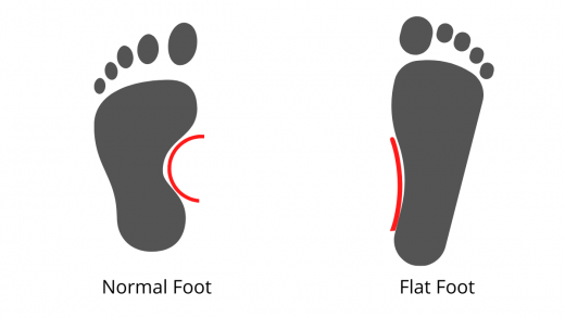 Shoe Inserts for Flat Feet: Types & How it Work : Physiosunit