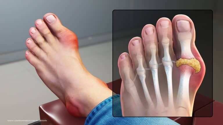 9 Pictures Of The Gout Symptoms Food To Avoid Other Tips Physiosunit