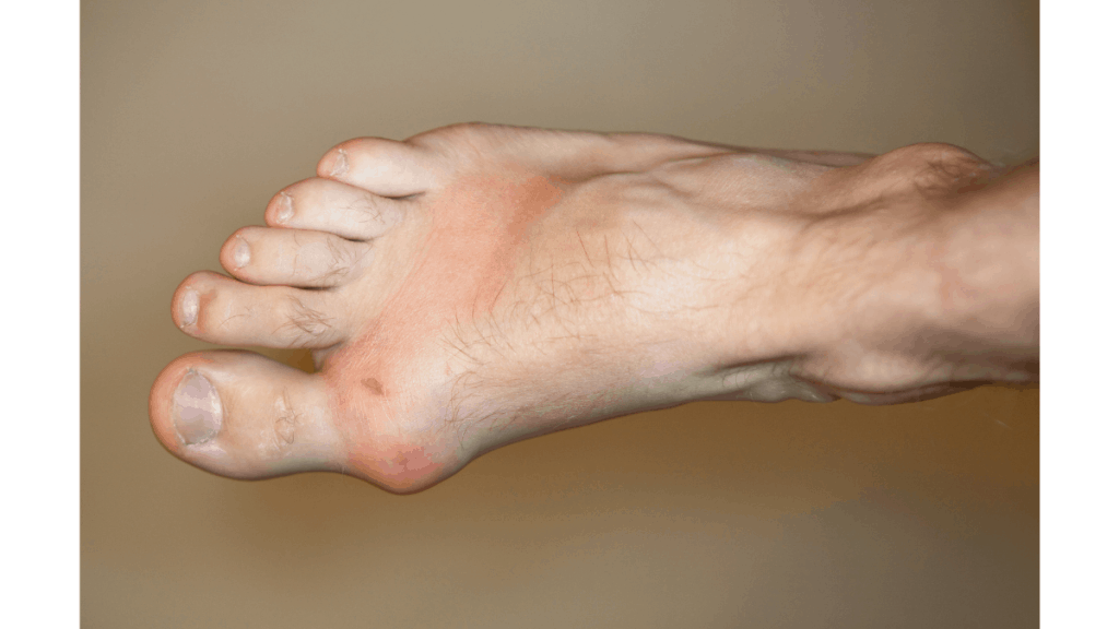 The Treatment Options For Gout In The Big Toe