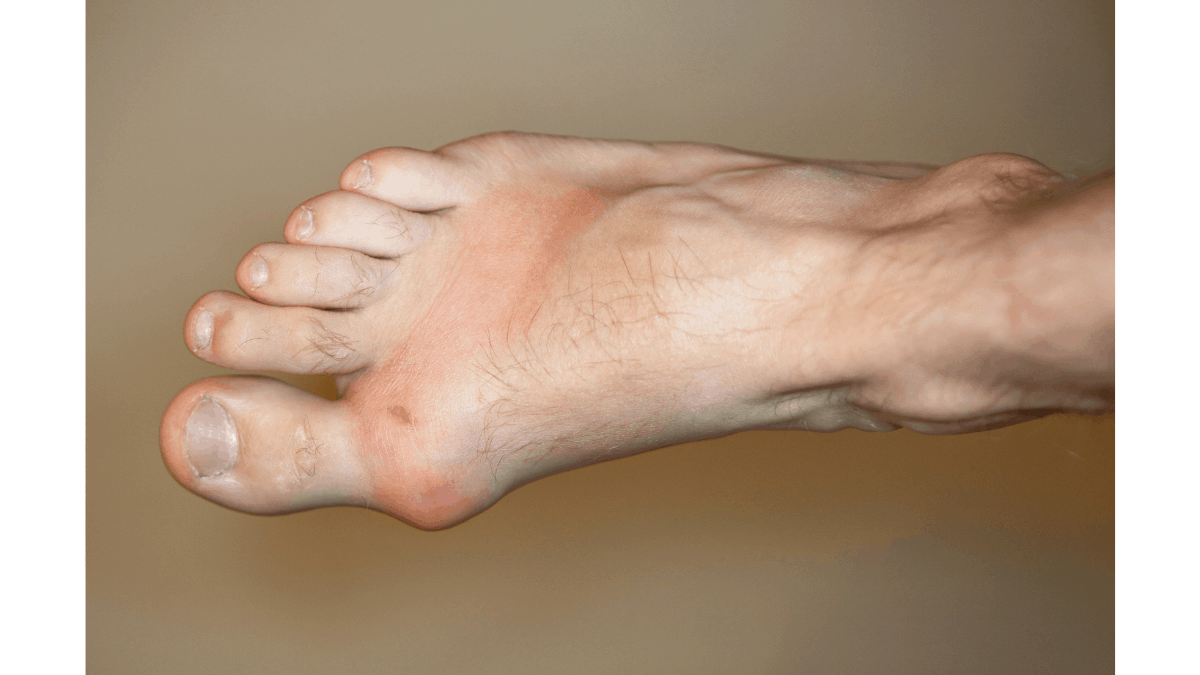 what is gout