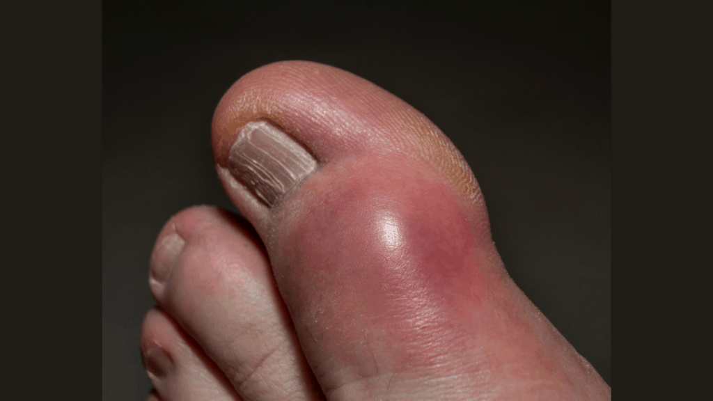 gout in big toe