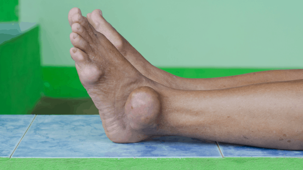 9-pictures-of-the-gout-symptoms-food-to-avoid-other-tips