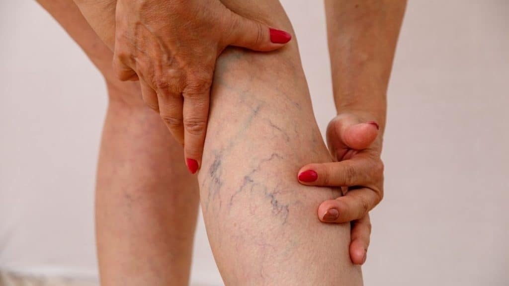 5 Best varicose veins exercises & tips for permanent cure