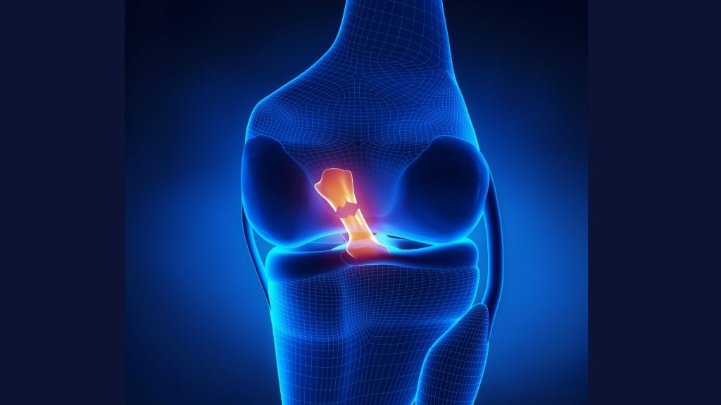 Symptoms of a Torn ACL, What to do at Home