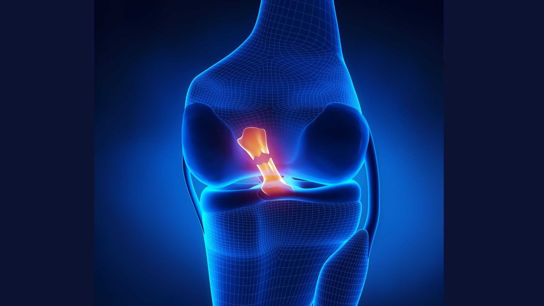 Symptoms of a Torn ACL, What to do at Home : Physiosunit