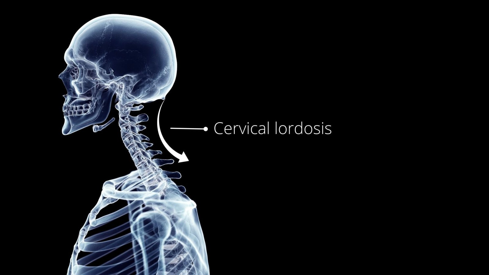 What is Cervical Lordosis Loss? Learn 5 Easy Cervical Curve Correction