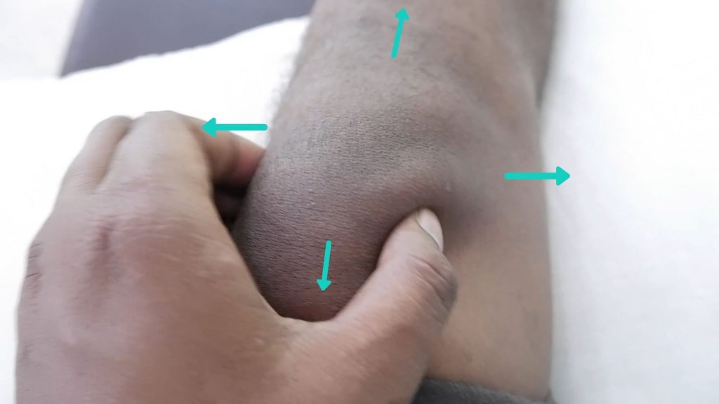 patella mobilisation knee rheumatoid arthritis