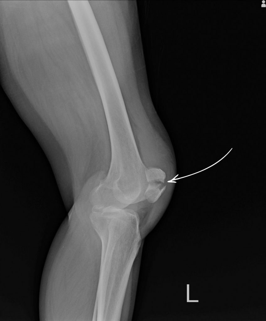 hairline fracture in knee