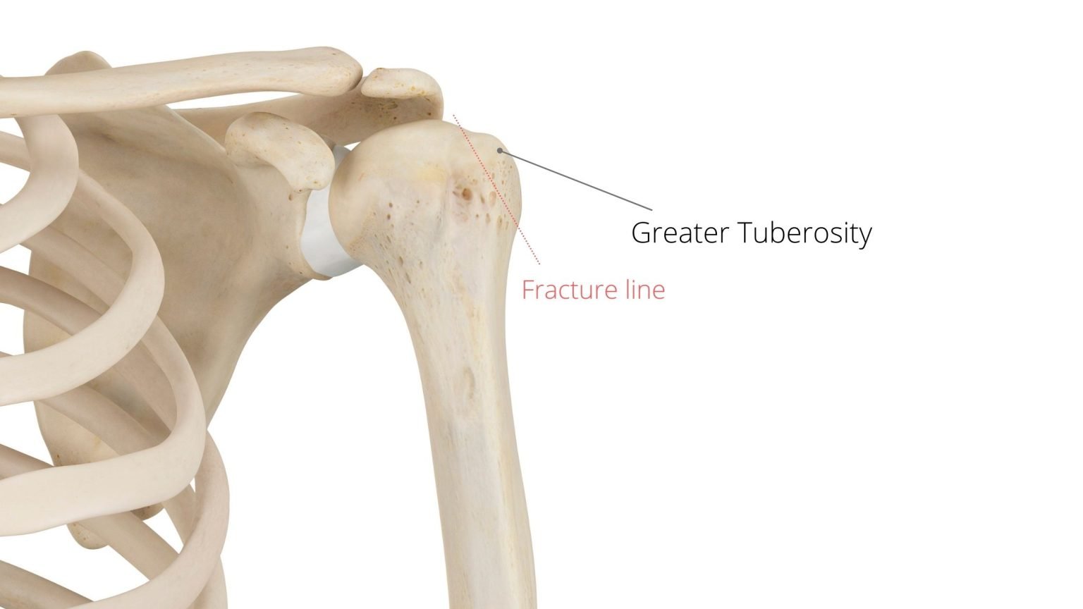 6 Easy Greater Tuberosity Fracture Rehabilitation Exercises - Physiosunit